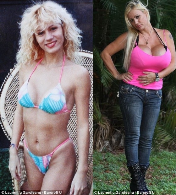 1990년 첫번째 수술한 뒤 모습과 현재모습 (Laurentiu Garofeanu).© News1 