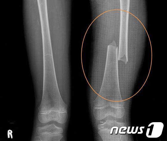 2012년 5월 계모의 학대로 골절된 이양의 엑스레이 촬영 대퇴부 골절 사진. (울산울주경찰서 제공) © News1  