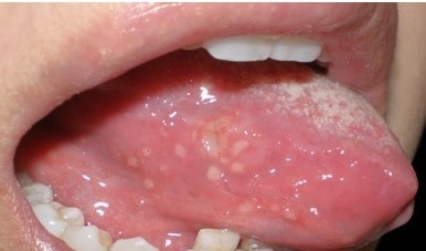 혓바늘 (서울대학교병원 제공)© News1  
