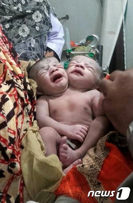 지난 12일 방글라데시 브라만바리아에서 태어난 샴쌍둥이 여야의 모습.ⓒ AFP=뉴스1