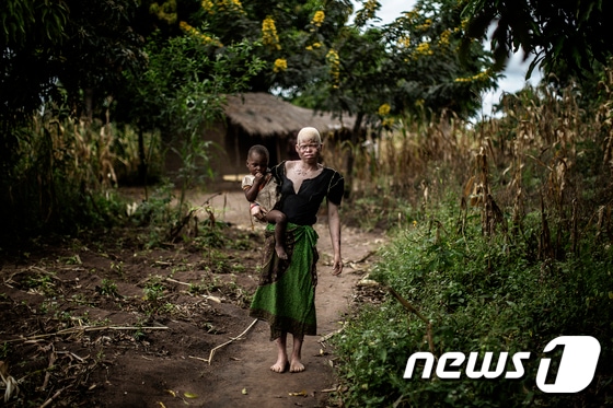말라위 마친가 지역에 사는 23세 알비노(백색증) 여성 마이나시 이사가 지난 4월 17일 2살배기 딸 드지아밀라 자팔리를 손에 앉고 서 있다. ⓒ AFP=뉴스1