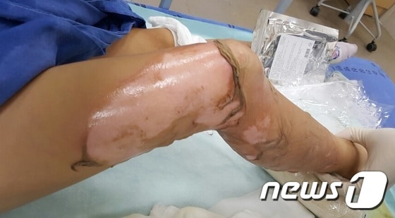 사고 당시 B양의 화상 부위 ⓒ News1
