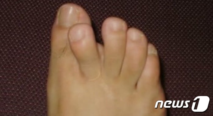 무소속 원희룡 후보측이 공개한 사고로 기형이 된 원 후보의 발가락(원희룡 캠프 제공)ⓒ News1