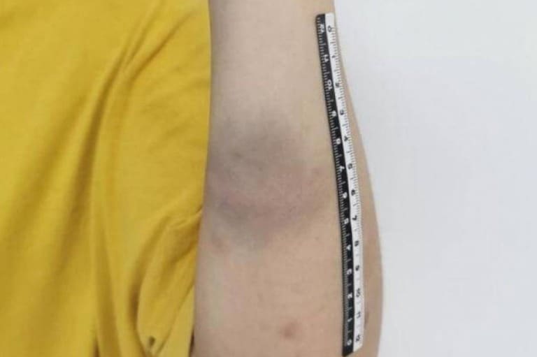 딸 린모씨의 팔에 난 상처 - 웨이보 갈무리