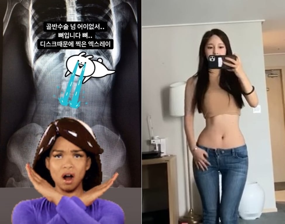 비현실적인 외모를 큰 화제를 모으고 있는 '여신강림'의 야옹이 작가가 골반을 찍은 X레이 사진을 공개했다. 인스타그램 갈무리 ⓒ 뉴스1