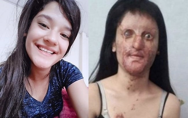 지난 2019년 전 남자친구로부터 염산 테러를 당한 버핀 오젝. (데일리스타 갈무리) ⓒ 뉴스1