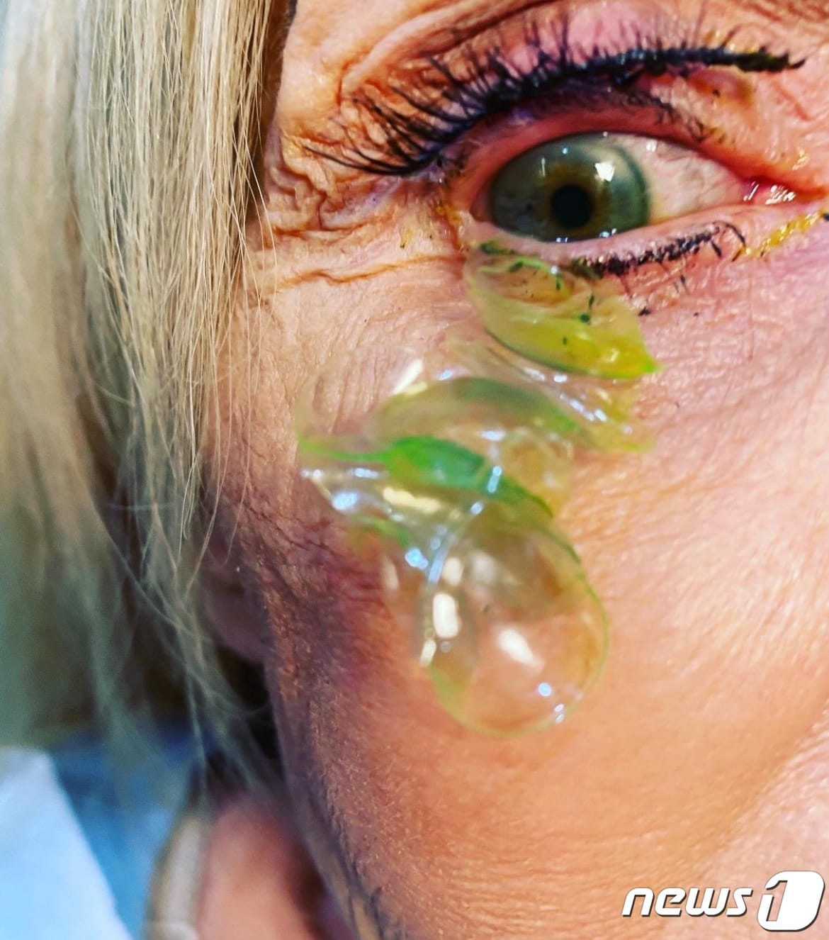 렌즈를 빼는 것을 잊은 70대 중반 여성의 눈에서 총 23개의 콘택트렌즈가 나왔다. (카테리나 커티바 인스타그램)