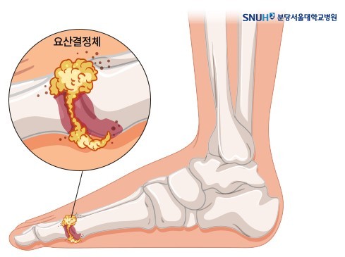 (분당서울대병원 제공)