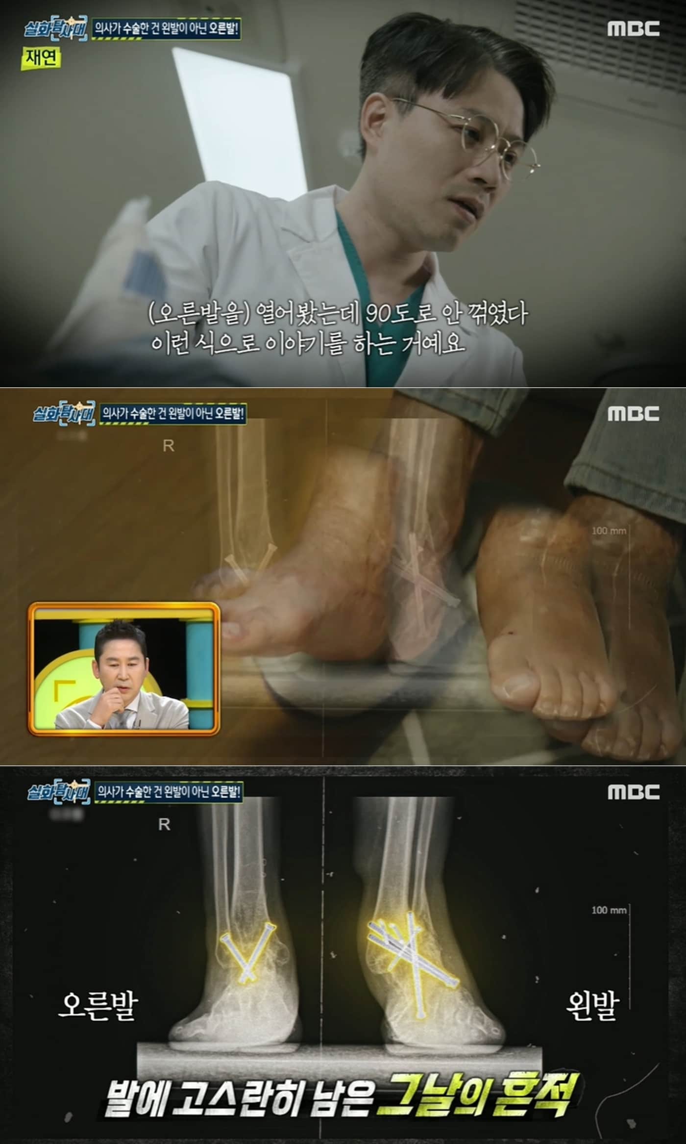 서울의 한 유명 병원에서 20대 남성 환자의 다친 왼발을 두고 멀쩡한 오른발을 수술한 황당한 의료사고가 발생한 것으로 전해졌다. 실화탐사대 발송 화면 갈무리