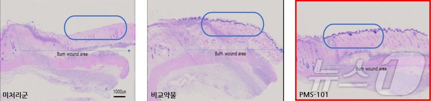 강스템바이오텍 계열사 프리모리스테라퓨틱스의 엑소좀 기반 화상치료제 PMS-101 효능 데이터. 화상 동물을 모델로 한 효력시험을 통해 PMS-101을 사용할 시 새로 성장하는 피부조직의 길이가 약물 미사용군 대비 45%, 현재 치료에 적용되는 약물 대비 23% 증가함을 확인했다.&#40;강스템바이오텍 제공&#41; /뉴스1 ⓒ News1 