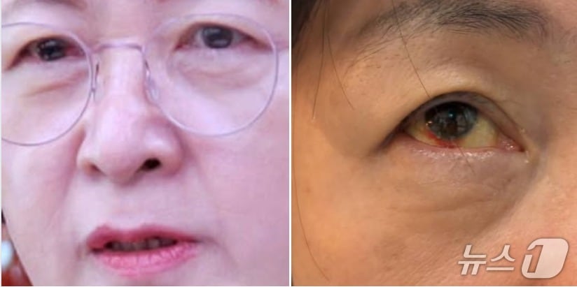 추미애 국회 법사위원장이 3일 자신의 SNS에 '국민의힘 비협조로 2025법사위 진행이 너무 힘들어 안구 실핏줄이 터지고 귀각 먹먹해 져 병원을 찾았다'며 충혈된 눈 사진을 올렸다. (SNS 갈무리) ⓒ 뉴스1 