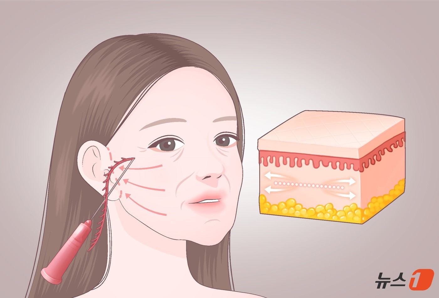 'K-미용의료 풀세트' 무바늘·레이저·HIFU 잘팔리네...수출 1조 원 돌파 - 뉴스 썸네일 이미지