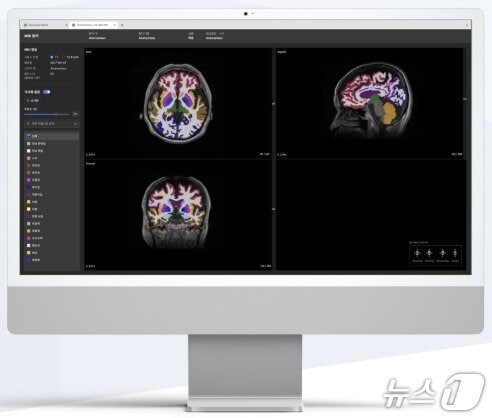 뉴로핏이 개발한 AI 기반 뇌 질환 진단 보조 소프트웨어 '뉴로핏 아쿠아' 활용 모습.(뉴로핏 제공)