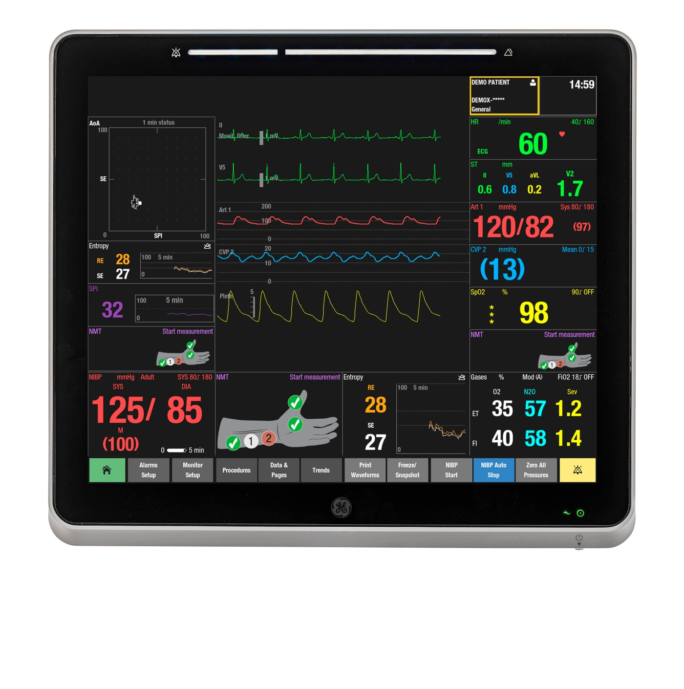 GE헬스케어의 환자모니터링 시스템 케어스케이프 캔버스(CARESCAPE Canvas)에 표기되는 'SPI 지표'. (GE헬스케어 제공)