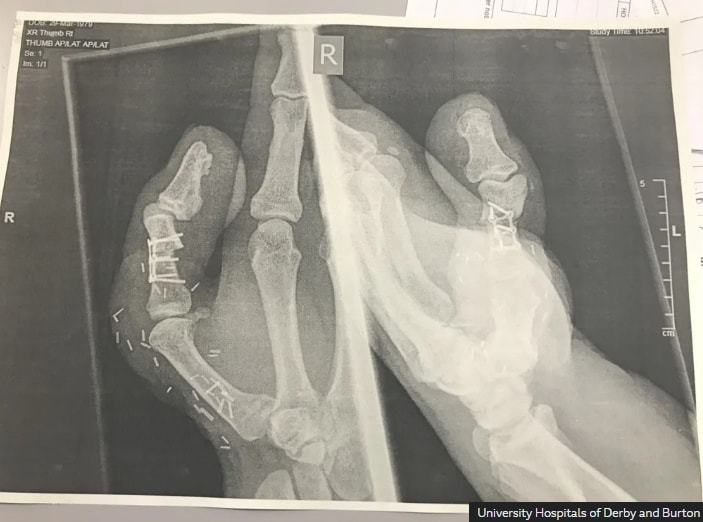 엄지발가락 이식후 사진. BBC