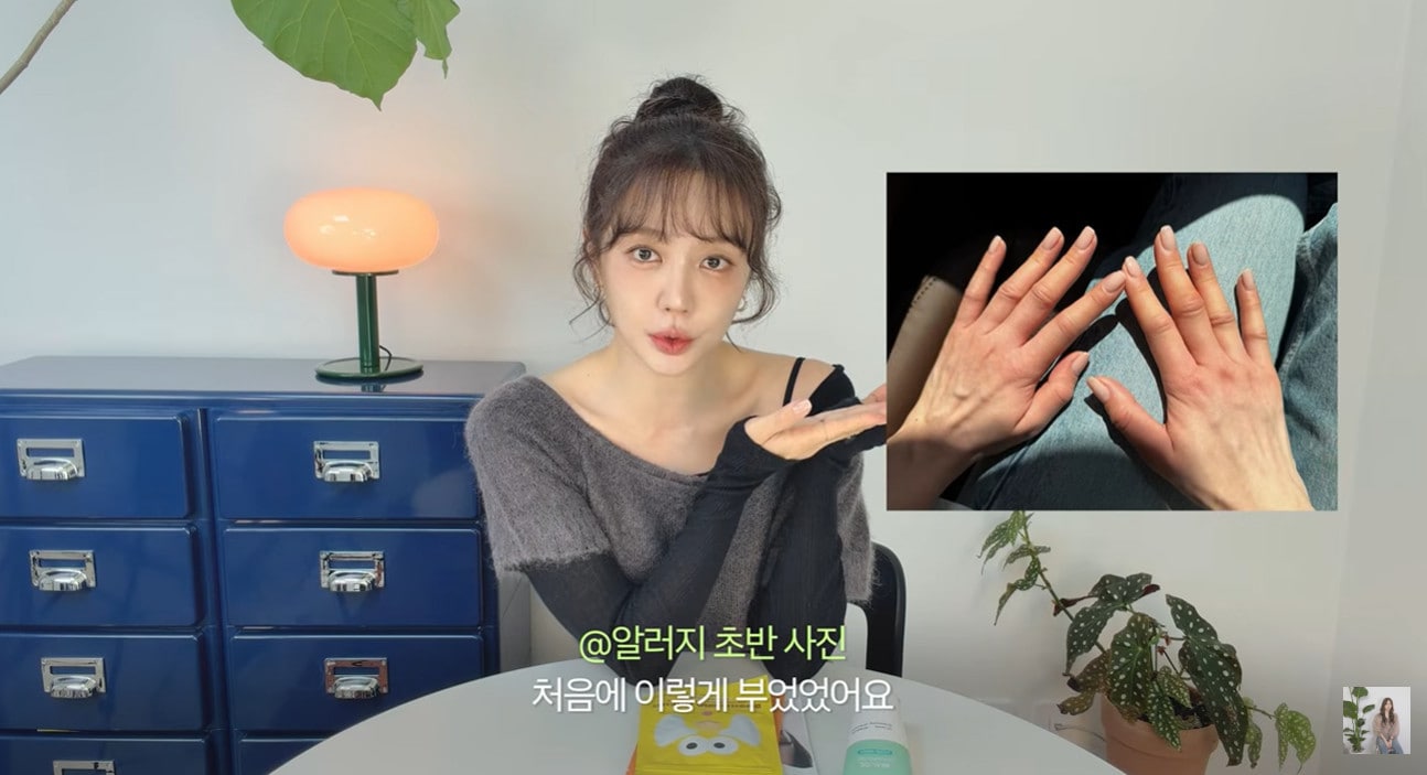배우 윤은혜, 심각한 알레르기 증상으로 3주간 투병